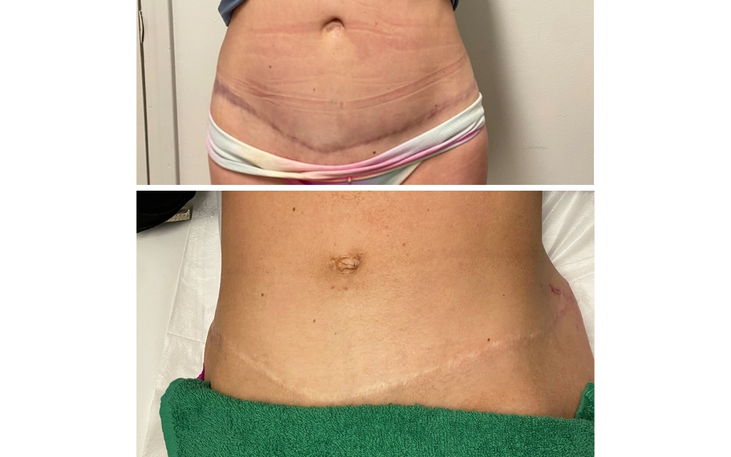 Top 5 Things to Know Before Getting a Scar Camouflage Treatment